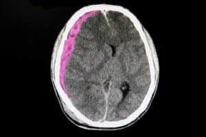 What Is a Subdural Hematoma?