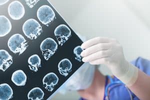 Undiagnosed Traumatic Brain Injury